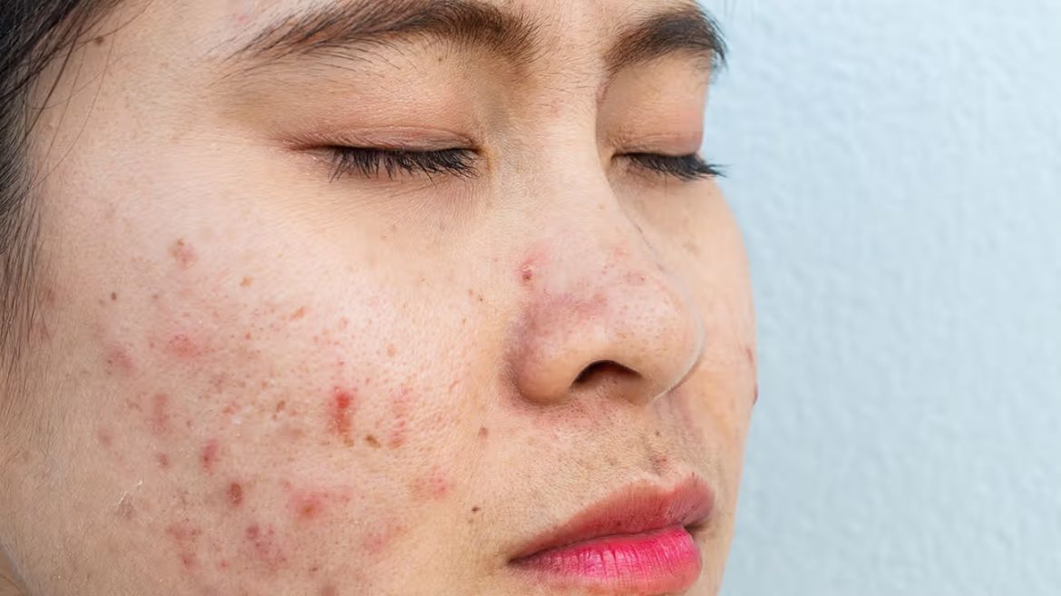 Five Skin Problem 5 Skin Problems, Causes and Remedies - Healthcares Option : Great ...